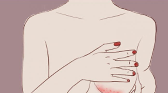 Rashes under the breast